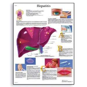 3B Scientific VR1435UU Glossy Paper Hepatitis Anatomical Chart, Poster 